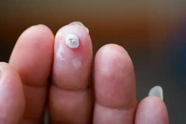 Image of white wart before cryopen treatment Newmarket