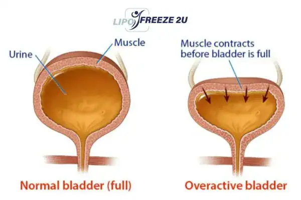 diagram of overactive bladder treatment Newmarket