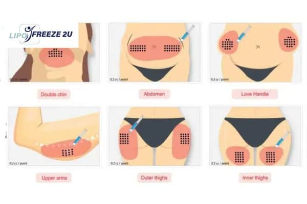 Benefits of Choosing Aqualyx for Fat Reduction Newmarket