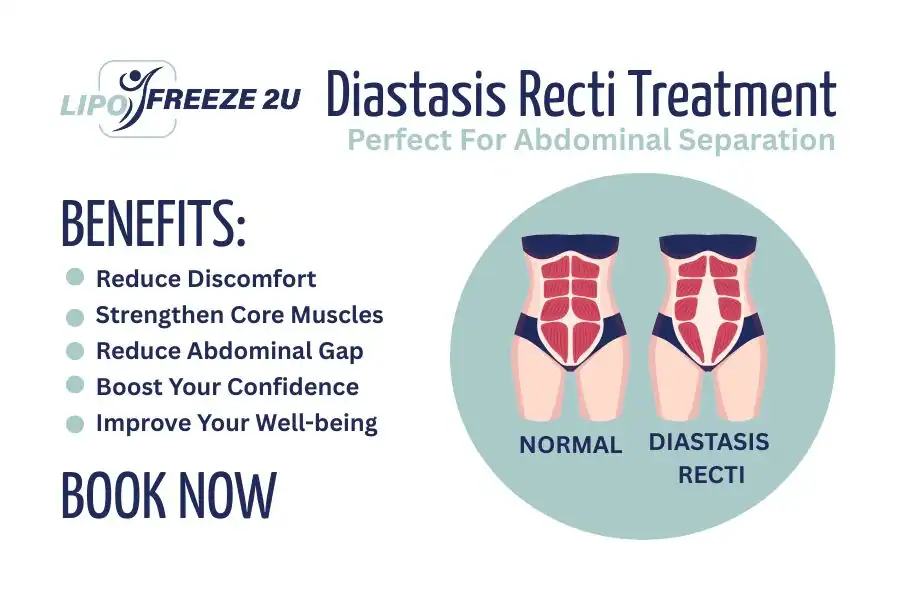 How Long Will It Take to See Improvements in Diastasis Recti Newmarket