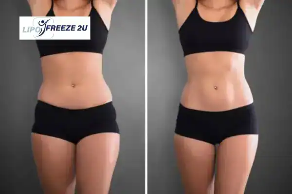 How Can LIPO FREEZE 2U Support Your Post-Pregnancy Body Recovery Newmarket?