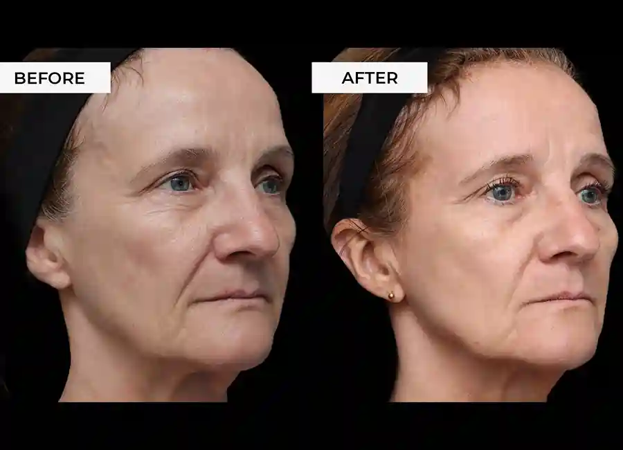 How Many RF Microneedling Sessions Will You Need to See a Difference Newmarket?