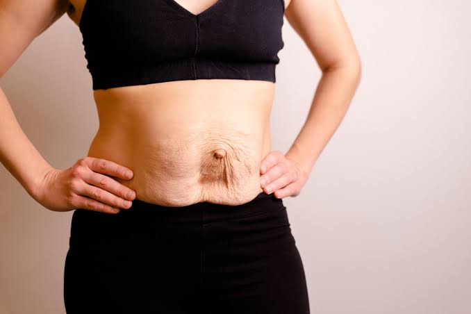 Is Surgery Really the Only Way to Repair Diastasis Recti Newmarket?
