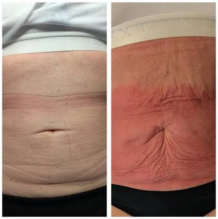 How Does RF Microneedling Improve Crepey, Thin and Uneven Skin Texture Newmarket?