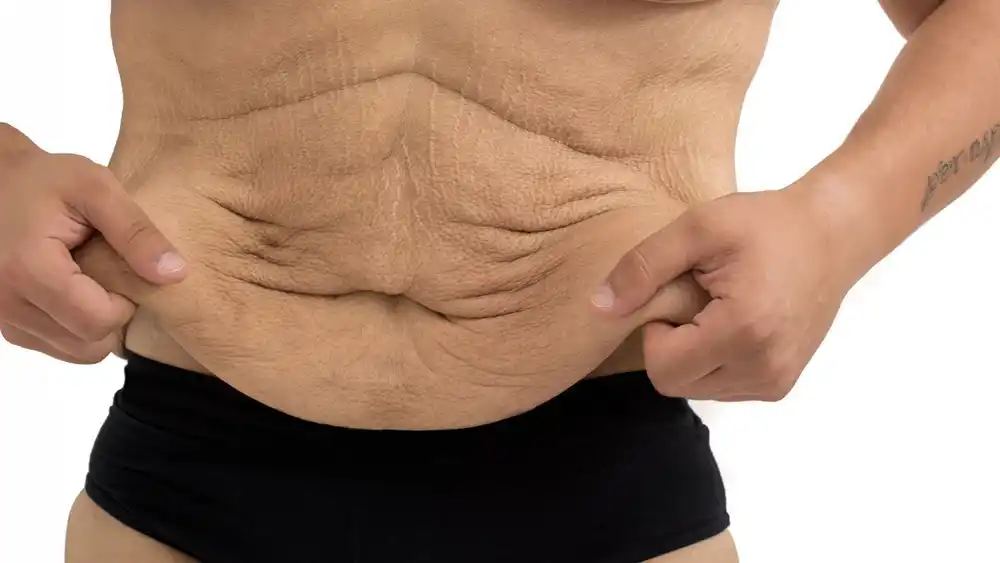 Why Does Weight Loss Medication Leave Some People With Loose or Sagging Skin Newmarket?